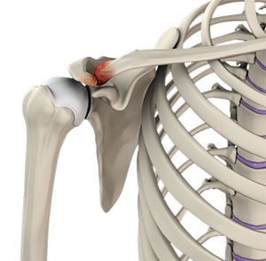 What Is Acromioclavicular Osteoarthritis