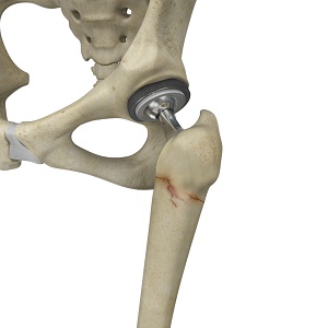 https://www.justinhudsonmd.com/3d-images/periprosthetic-hip-fractures.jpg